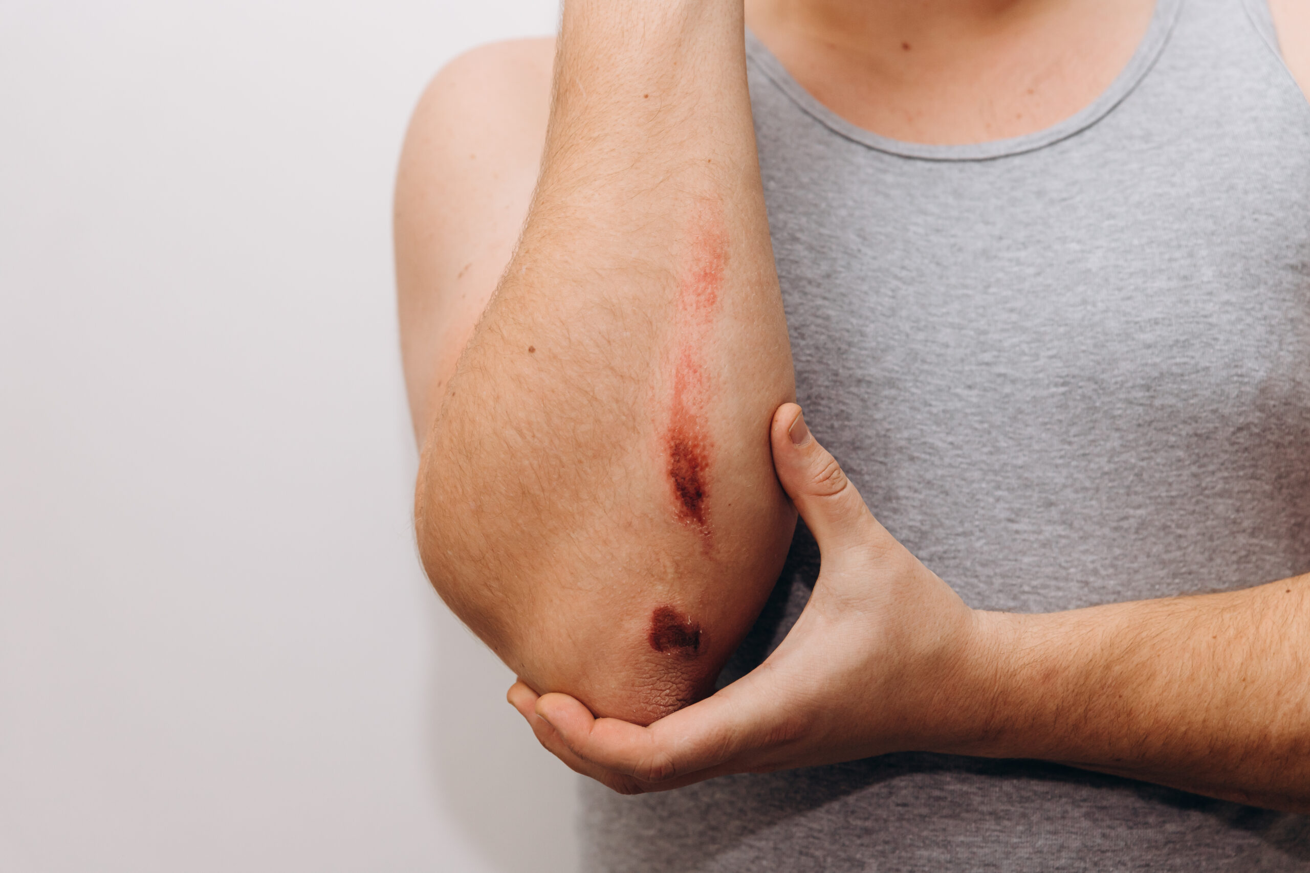 man met wonde aan de voorarm