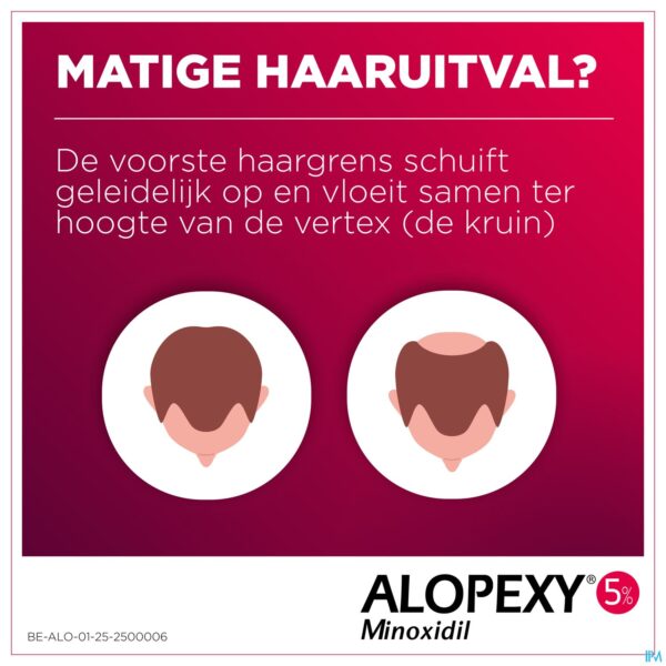 Lifestyle_image Alopexy 50mg/ml Opl Cutaan Gebruik Fl Pipet 60ml