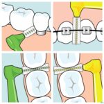 Lifestyle_image Tepe Angle Interdental Ragers Blauw 0,6mm 6 154640